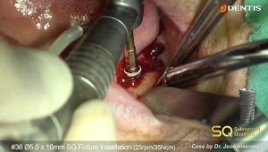 Immediate implant placement after extraction 관련사진