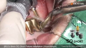 Simple implant surgery on lower posterior with SQ Short 관련사진
