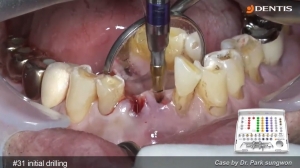 Immediate implant placement & loading 관련사진