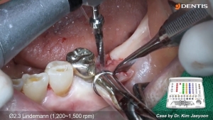 Limited flap implant placement on posterior area & removal of interfering bone 관련사진