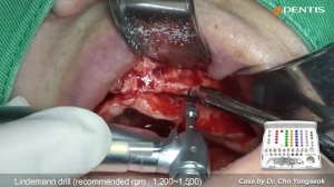 Mx. Full mouth with  both LSBA surgery 관련사진
