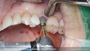 Flapless implant placement and immediate loading with CEREC 관련사진