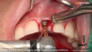 #21 Immediate Implant Placement, buccal socket GBR 관련사진