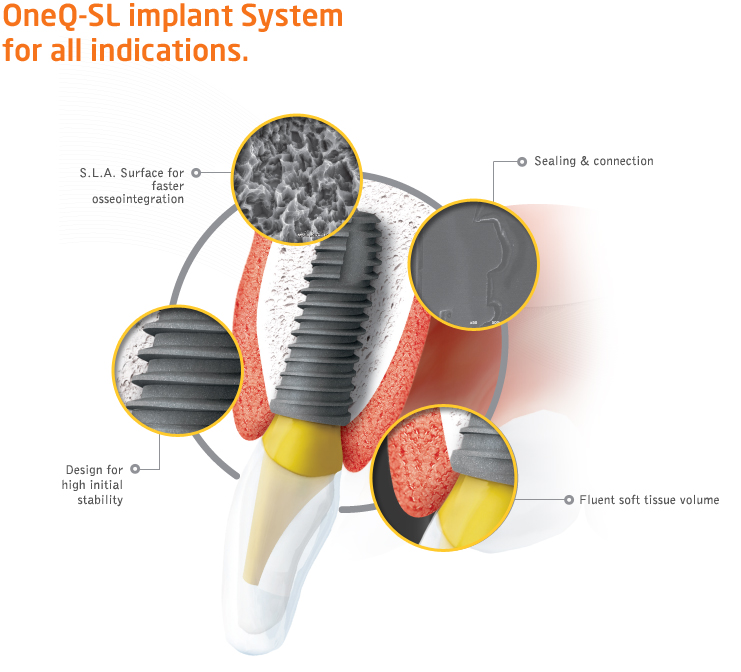 OneQ-SL implant System for all indications.