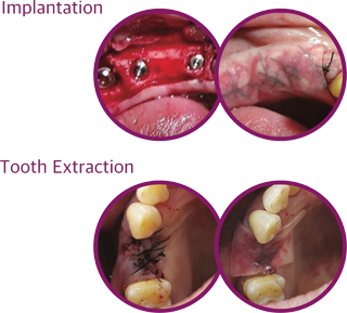 After Implantation&Tooth Extraction 이미지