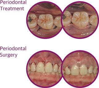 After the Treatment of Periodontal Disease A 이미지